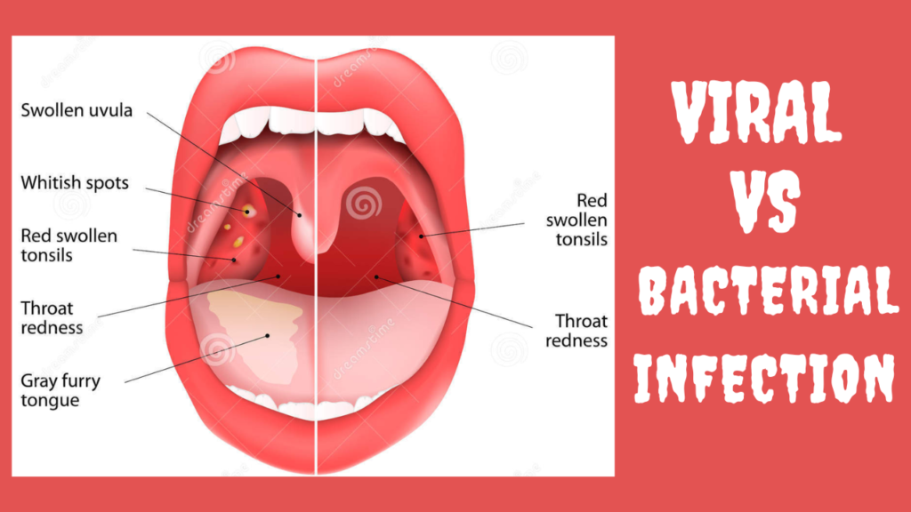 Difference between Viral and bacterial infection